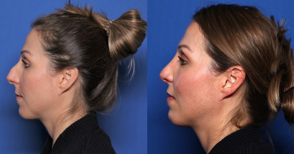Before & after photos of one of Dr. Camp's rhinoplasty patients