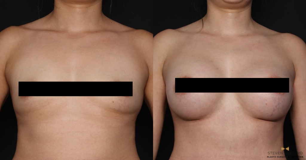 Before & after photos of one of Dr. Camp's breast augmentation patients