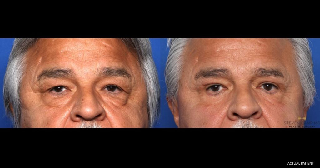 Male eyelid surgery (blepharoplasty) patient results before and after surgery with Dr. Steven Camp