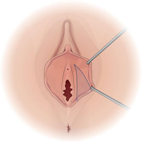 Labiaplasty illustration - wedge technique