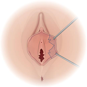 Labiaplasty illustration - trim and edge technique