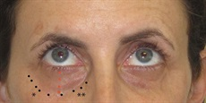 Female lower eyelid surgery patient example illustrating the treatment area