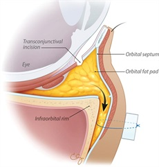 Illustration of surgical incision required for lower eyelid surgery