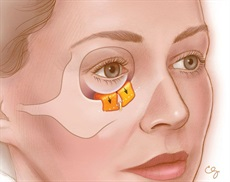 Illustration of repositioning the skin during lower eyelid surgery