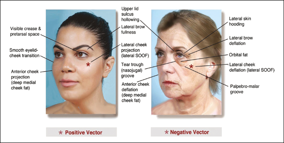 Diagram illustrating signs of aging around the eyes on a younger and older patient