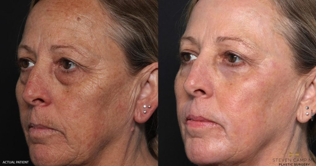 Female lower eyelid surgery (blepharoplasty) patient results before and after surgery with Dr. Steven Camp