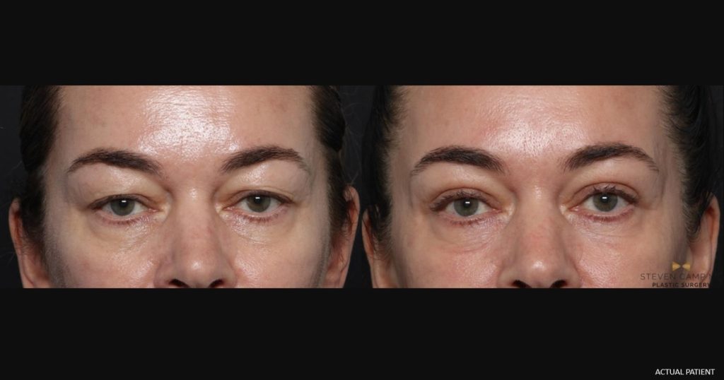 Female upper eyelid surgery (blepharoplasty) patient results before and after surgery with Dr. Steven Camp