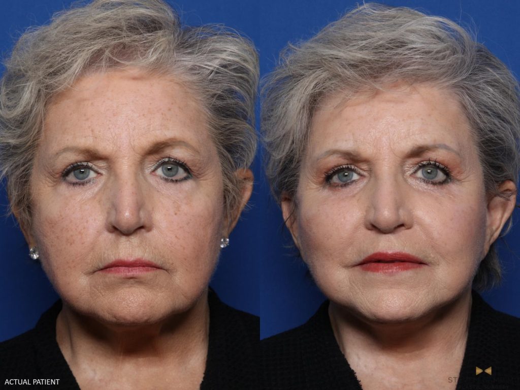 Female patient who had a previous facelift and eyelid surgery. Dr. Camp performed upper and lower eyelid surgery, facelift, neck lift, upper lip lift, facial fat grafting, and a brow lift