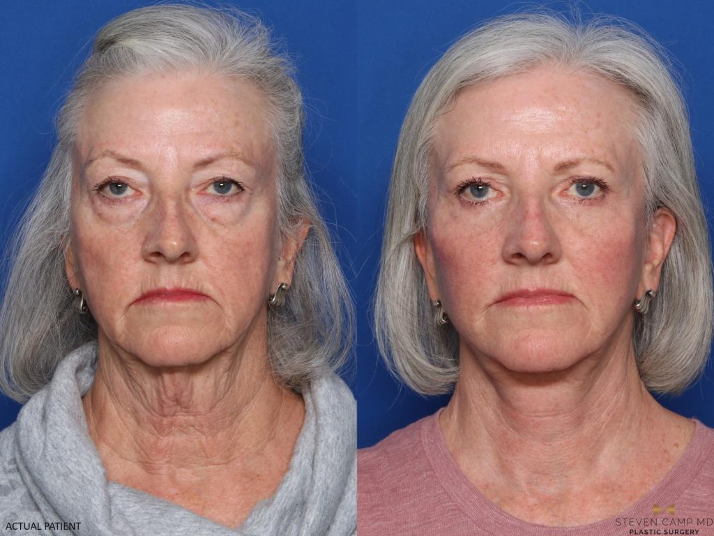 Dr. Camp combined upper and lower eyelid surgery with a facelift, neck lift, facial fat grafting, and Sciton HALO and BBL laser skin treatments