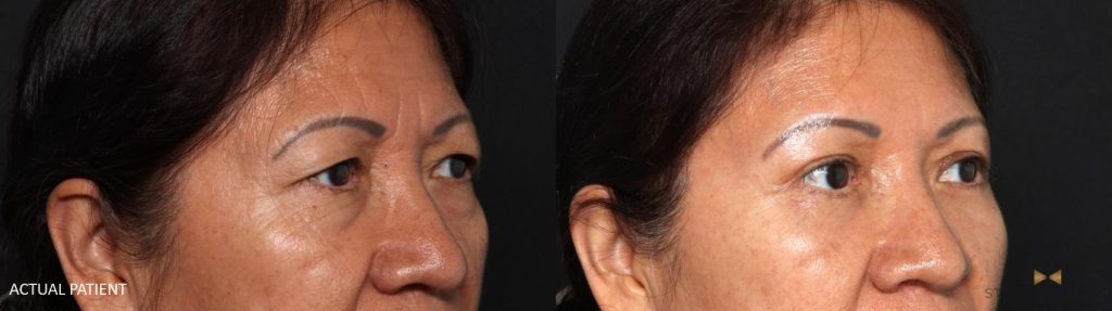 Upper eyelid patient who underwent a simultaneous brow lift