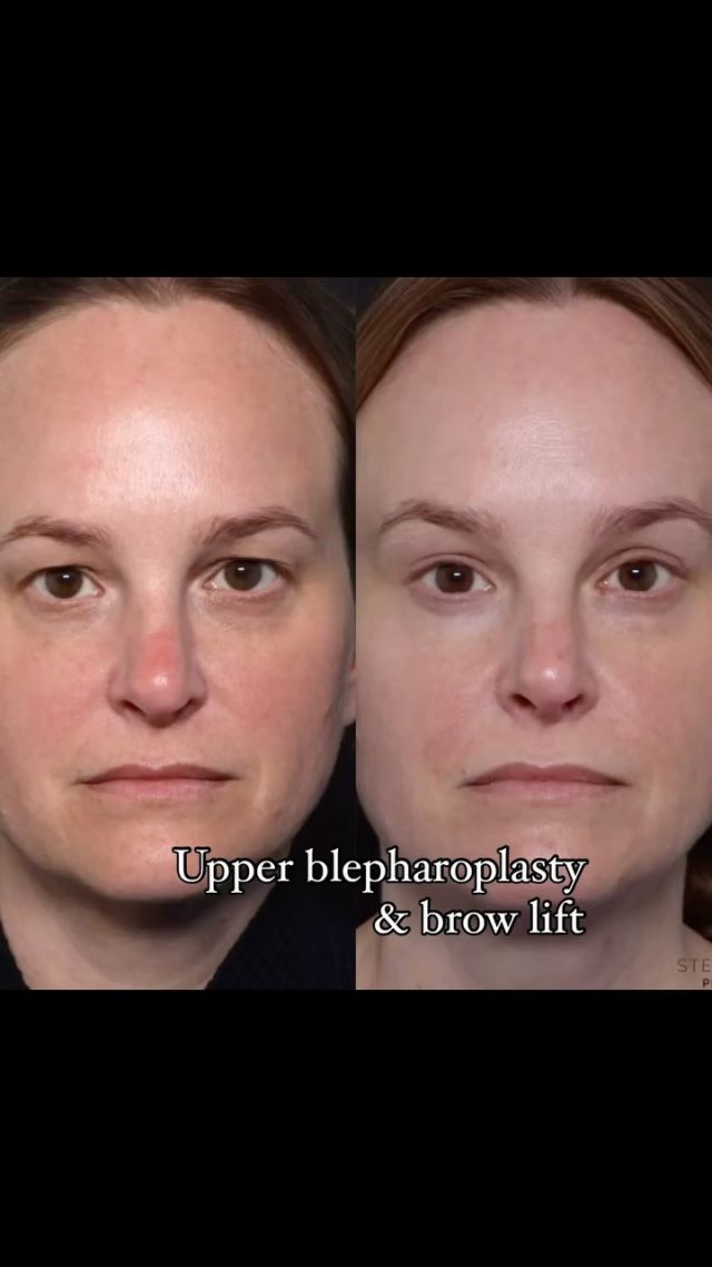 A brow lift combined with an upper blepharoplasty (eyelid surgery) can be important for several reasons:

	1.	Comprehensive Rejuvenation: A brow lift addresses sagging or drooping of the eyebrows, which can make a person look tired or older. Upper blepharoplasty removes excess skin and fat from the upper eyelids, reducing hooding and improving the appearance of the eyes. Together, these procedures provide a more balanced and youthful appearance.
	2.	Enhanced Results: When performed together, these procedures can enhance each other’s results. Lifting the brow can prevent the upper eyelid from becoming heavy again soon after the blepharoplasty, while the eyelid surgery can refine the contours around the eyes for a more complete rejuvenation.
	3.	Functional Improvement: Excess skin on the upper eyelids can sometimes interfere with vision. By combining a brow lift with upper blepharoplasty, both the aesthetic and functional aspects are addressed, potentially improving the patient’s field of vision.
	4.	Symmetry and Balance: Performing both procedures at the same time can ensure better symmetry and balance in the facial features. This is because the position of the eyebrows can affect the appearance of the eyelids and vice versa.
	5.	Single Recovery Period: Combining the procedures means only one recovery period, which can be more convenient and less disruptive for the patient.

Overall, a brow lift with upper blepharoplasty can provide a more harmonious and rejuvenated appearance, addressing multiple concerns in one surgical session.