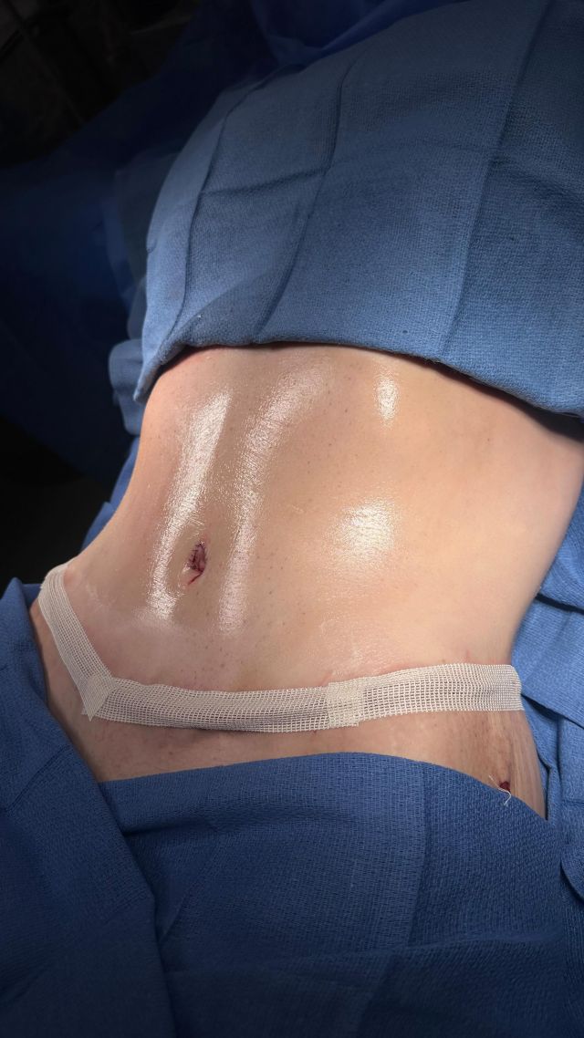 A great update from clinic, just 24 hours post extended tummy tuck.

Do you have questions about #tummytuck procedure or recovery, comment below 👇 

#fortworthplasticsurgeon #dfwplasticsurgeon