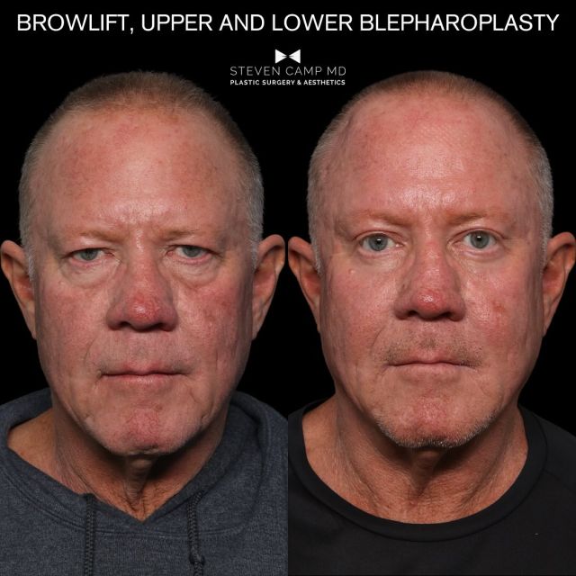 Results that speak for themselves. 

An endoscopic approach Brow Lift combined with an Upper and Lower Blepharoplasty gave my patient a full eye refresh, addressing his concerns and taking years off of his appearance. These results are only 3 months post procedure. 

#browlift #blepharoplasty #facialrejuvination #fortworthplasticsurgeon #dfwplasticsurgeon