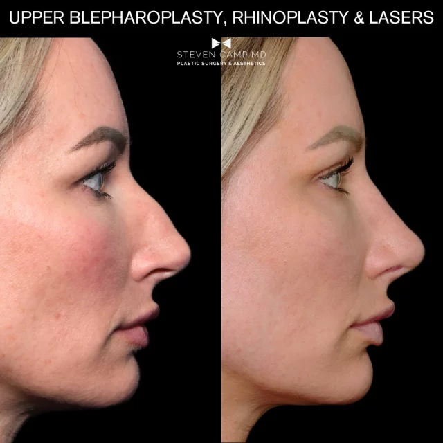 You can always see a good rhinoplasty in the patients eyes. The person just tends to look brighter and more vibrant. This patient is shown just 6 weeks post rhinoplasty and blepharoplasty. So in this particular patient we doubled down on bringing her eyes into focus. We also did laser resurfacing in the OR with our @sciton lasers using Halo, fractional resurfacing, #bbllaser and Moxi. 

When you look carefully at the eyes, the nose, and the skin you can see the refinements in each area. The eyes are brighter and more open and the hooding of the eyes is gone. The nose is straighter, smoother with removal of the dorsal hump, and a more refined and lifted tip. The skin is smoother, with improved texture and tone, correction of pigments with reduced brown spots and areas of rosacea have been calmed. 

She looks natural and polished and we are happy she is happy, and allowed us to share these results with all of you. I also love this result because it shows how I combine treatments for patients to optimize results in a harmonious way. Be your best. Do things that make you happy. ✌️

#fortworthplasticsurgeon #dfwplasticsurgeon #rhinoplasty #scitonlaser #laserresurfacing #bbllaser #moxilaser #halolaser