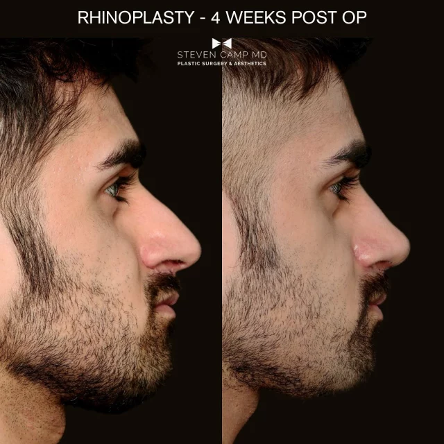 Here’s an early look at a recent rhinoplasty case on a male patient. When we talked in the office I was struck by his kindness and thoughtful approach towards his goals. He told me he wanted to look natural but more relaxed. He felt like his nose was a bit long for his face, he wanted a smoother profile with less dorsal hump, and correction of a drooping tip which especially bothered him in smiling. 

The case had another challenge because the patient had an upper lip lift previously with another surgeon. This created some tension on his smile and added a layer of challenge towards shaping the nose and the lip. Ultimately I performed his rhinoplasty using ultrasonic piezo surgery to sculpt the bones and narrow the nose and I also revised his lip lift with alar base resections. Even in the early phase things are looking good. The result shows a more natural nose that fits his face. Additionally, improving the tip rotation and support as well as correcting his deviated septum has improved his breathing. He also has a more relaxed lip posture due to changing some of the dynamics of his prior lip lift. 

He told me he feels more relaxed and confident. I’m happy he is doing well and trusted me to take care of him. Pretty cool stuff.  Cheers 🥃

Have questions about rhinoplasty? Comment below 👇 

#dfwplasticsurgeon #fortworthplasticsurgeon #fortworthrhinoplasty #dfwrhinoplasty #rhinoplasty