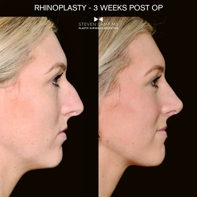 Rhinoplasty: 3-Week Post-Op Update

Swipe through to see how our patient’s nose is healing just three weeks after surgery!
While these results are already beautiful, it’s important to remember that rhinoplasty healing is a journey:

🔎 What to Expect at 3 Weeks:
- Most swelling has subsided, but subtle swelling (especially at the tip) is still normal. 
- Bruising, if present, continues to fade.
- Results will continue to refine over the next 6-12 months as the nose settles into its final shape.

Every rhinoplasty is customized to the patient’s unique anatomy and goals.
Curious about what’s possible for you?

#rhinoplasty #fortworthplasticsurgeon #dwplasticsurgeon #nosejob #postop