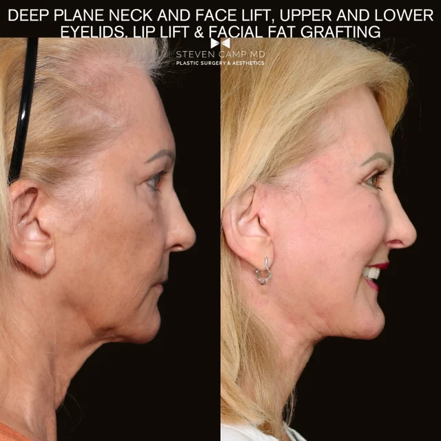 Here is a comprehensive facelift case shown 6 months post op. I performed a deep plane facelift, deep structural neck lift with submandibular gland resection and digastric muscle contouring. The case was interesting because she’s had eyelid and facial procedures before so I needed to work around some things and restore as much as I could safely. 

She had revision upper and lower lid surgery with fat transposition, fat grafting to some areas of thinning skin quality, with laser resurfacing using @sciton lasers with erbium which is the best of the best laser and a step up from CO2 in my opinion and in publications on the subject of lasers. Her facelift and neck lift plus the ancillary procedures has become a focus in my practice and it’s clear to see a more vibrant and refined facial shape and appearance. 

The key for me is the deep layer release and repositioning of the aging process. In my mind we rotate and advance falling tissues where they should be to optimize shape and highlight the beautiful features like beautiful cheeks, smooth eyes, and a crisp youthful neck with no jowls. The result is a healthier glow and refreshed look. As usual there is a lot to say about facial rejuvenation and also there is more than one way to get nice results. This is just one of example of my approach to things. The key for me is our surgical goals and results matched the patient in her wishes and on her terms. Drop a line let me know what you think. I look forward to engaging for all that are interested. ✌🏻