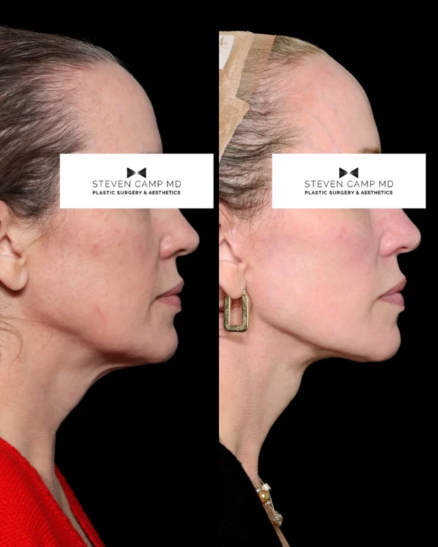 The deep plane facelift helps create a more defined and beautiful jawline by addressing the signs of aging and sagging skin that can affect facial structure. 

When working in this area a facelift removes excess skin and tightens the underlying tissues, which helps improve the contour of the jawline.  It can be subtle, but once you start to notice the crispness of a nice jawline, it’s hard not to notice the presence or lack of one around you. As you will see on this patient who graciously shared her before and after photos captured 2 years after surgery, her jaw is smooth and also there is a wonderful reduction in the sagging that was beginning to occur. 

You will notice the nice smoothing on the frontal view with her neck.  Those horizontal lines, also known as “tech neck” are diminished with deep facelift and necklift procedures. 

As your eye travels up, you will see a more pronounced cheek area.  While thankfully we are moving away from overfilled cheeks of the past, her cheeks have a nice youthful pop. 

Additionally, through two consistent years of medical grade skincare with @skinceuticals and lasering with @sciton, this patient really allowed her skin to look refreshed and younger.  

Thanks for supporting her and our practice as we highlight our facial plastic surgery work alongside our breast and body work.  As always, our whole team is here to bring you our best. 
#deepplanefacelift #deepplanenecklift #facialplasticsurgery #fortworthplasticsurgeon #facelift #necklift #facialaging