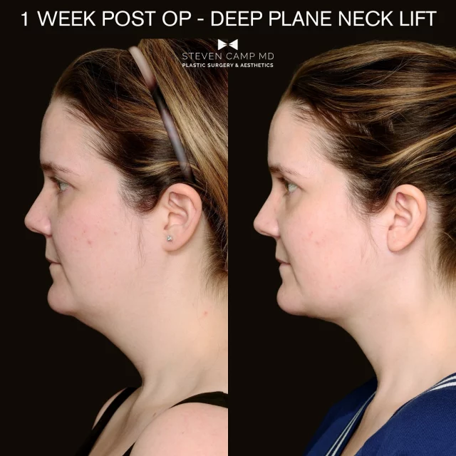 When it comes to neck sculpting it’s important to go deep or go home. The deep contents of the neck often contribute to heaviness and lack of contour along the jawline and it’s important to unload the neck to reshape it in a youthful manner. This case is an example of the power of a deep neck lift. With liposuction, or energy based “skin tightening” thread or filler these results would not be obtainable. The reason is because the fullness in the neck was deep behind the delicate superficial neck area and thin platysma muscle. It takes an expert experienced in facial surgery to surgically contour the deep neck, the digastric muscle and the submandibular gland for reduction in the heaviness in the neck. Additional finesse moves include hyoid fasciotomy to allow for a laryngeal set back and better angles for an elegant, crisp and elongated neck that remains soft. 
Only ONE WEEK post Deep Plane Neck Lift, and the transformation is already remarkable!

What do you think 🤠

#DeepPlaneNeckLift #FacialSculpting #NeckRejuvenation #FacialRejuvination #FortWorthDeepPlaneNeckLift