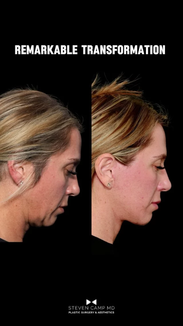 Elegance starts with a sculpted neckline. 

One thing that my patients notice about aging is the Neck. In my opinion a beautiful neck with a clean jawline is the most elegant and beautiful part of a deep plane face and neck lift. It is a subtle crisp change that makes everyone confident and sparks the question what have you been doing because you look amazing. Not what did you have done. This is the point. You look better, fresher, like yourself, but not artificial or operated upon in your look. 

The neck is a tough place to reset and rejuvenate and it’s where proper surgery makes a difference. Fundamentally aging hollows and volume loss can be improved with volume and injections but true sagging responds best to a lifting treatment that resets and repositions age related sagging. 

Lately, more patients are asking me for facelift and neck lift procedures for several reasons listed below. 
    1.    Aging Signs: As women enter their 40s, they may begin to notice visible signs of aging such as sagging skin, wrinkles, and loss of skin elasticity, especially around the face and neck. A face and neck lift can address these issues by tightening the skin and underlying tissues.
    2.    Preventive Measures: Some women choose to undergo these procedures earlier as a preventive measure to maintain a youthful appearance for longer. It’s often easier to address aging issues at a younger age than to wait until they become more pronounced.
    3.    Improved Self-Confidence. Many patients feel that looking more defined and contoured especially along the jawline and neck provides an elegant and confident look. The confidence that comes with this is more than looks, it’s an emotion and joy in living. It’s a real thing. 
    4.    Technical Advancements: With advances in cosmetic surgery techniques procedures are more targeted to areas of the deep face and neck leading to structural improvements that are cleaner, more durable, and put less pressure on the skin. It makes results more natural and scars less noticeable. More elegant results with truly undetectable scars. 
Continued in comments.